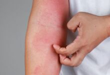 Photo of What to recognize about bloodless-triggered allergies