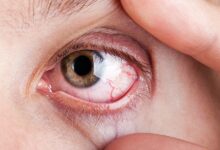 Photo of Eye Burning Home Remedies – How To Get Rid of Eye Pain