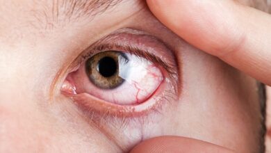 Photo of Eye Burning Home Remedies – How To Get Rid of Eye Pain