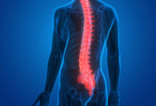 Photo of Spinal Cord Injury Treatment and Rehabilitation in the United States