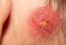 Photo of Staph Skin Infection Treatments – Is There A Cure For Staph?