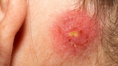 Photo of Staph Skin Infection Treatments – Is There A Cure For Staph?