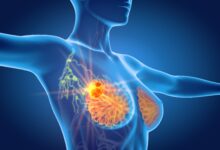 Photo of How to Treat Metastatic Breast Cancer – The Most Effective Treatment
