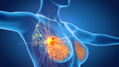 Photo of How to Treat Metastatic Breast Cancer – The Most Effective Treatment