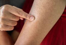 Photo of The Difference Between Bumps and Keloid