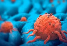 Photo of Some Colorectal Cancers Are “Born To Be Bad,” Have Already Spread Long Before Diagnosis