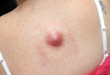 Photo of What causes a lump on the areola