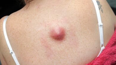 Photo of What causes a lump on the areola