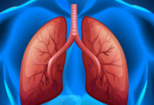 Photo of Managing Multifocal Pneumonia: Treatment and Prevention