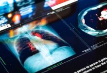 Photo of Understanding Multifocal Pneumonia: Multiple Lung Infections