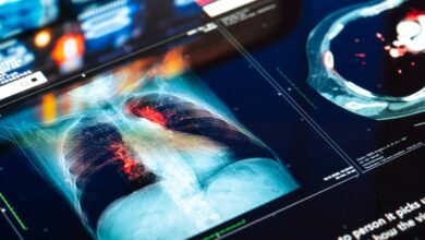 Photo of Understanding Multifocal Pneumonia: Multiple Lung Infections