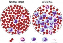 Photo of Understanding Normal MPV Range in Blood
